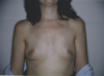 Breast Augmentation Before Picture